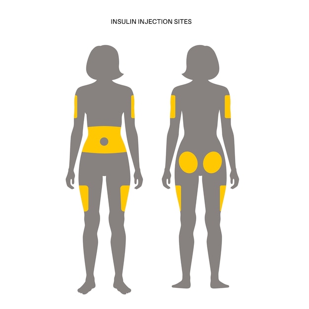 Лечение диабета места инъекций инсулина на плоском векторе тела взрослой женщины человека