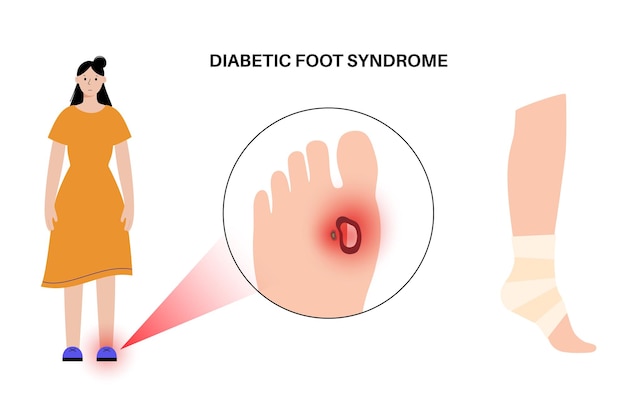 Sindrome del piede diabetico ulcera profonda, ferita aperta o ferita ai piedi infiammazione dei legamenti, dei tendini e delle ossa infezione da cancrena e amputazione dolore alle gambe vettore diagnostico e terapeutico