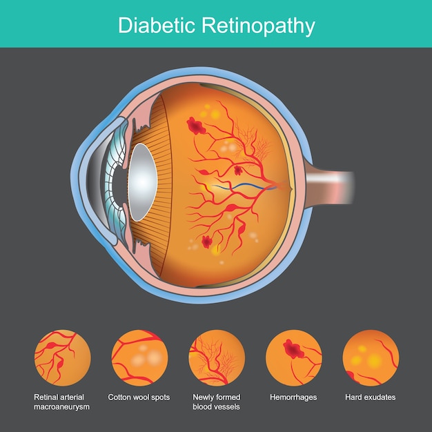 Illustrazione di retinopatia diabetica