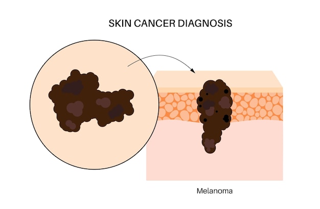 Vector diagnose van huidkanker