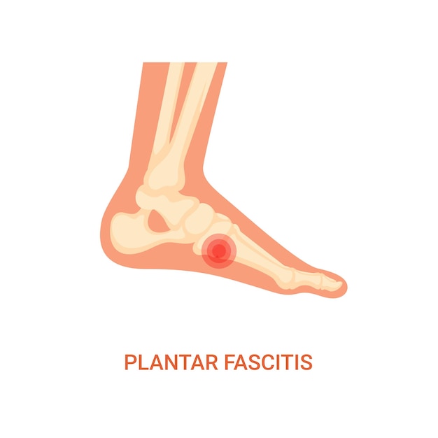 Vector diagnosis of plantar fasciitis disease