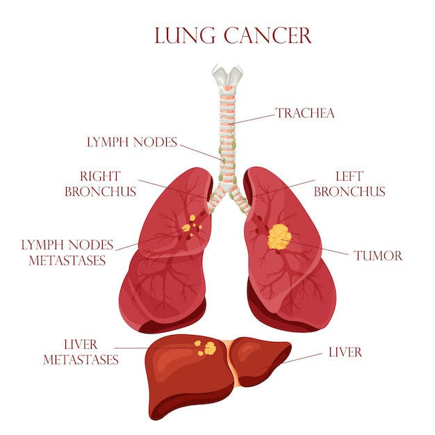 Diagramma della malattia del cancro del polmone malattia concettuale degli organi interni umani illustrazione vettoriale in stile cartone animato