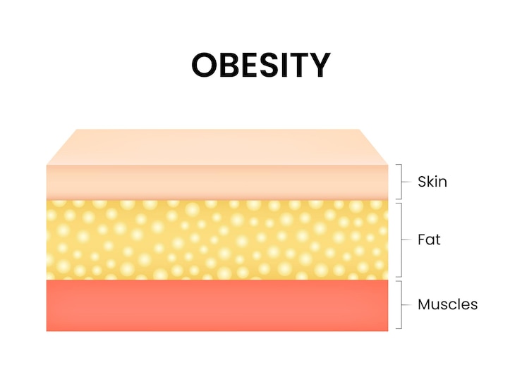 वेक्टर diagram of obesity and overweight layers skin