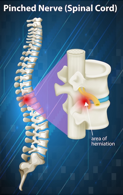 Vector diagram of pinched nerve at spinal cord