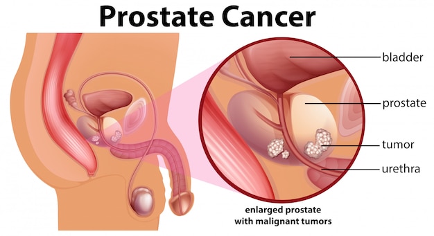 Diagramma del carcinoma della prostata