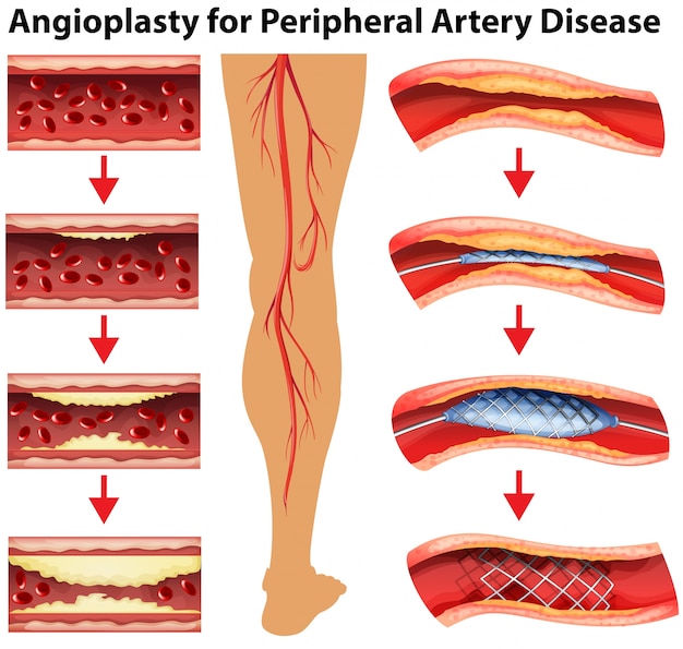 Vector diagram showing angioplasty for peripheral artery disease