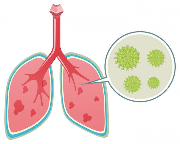 Diagramma che mostra il coronavirus nei polmoni umani