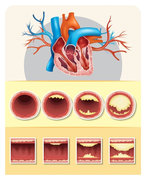 Vector diagram showing fat in human heart