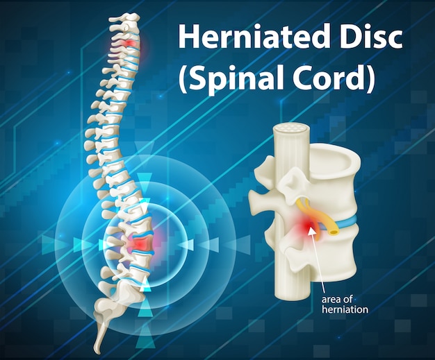 Diagram showing herniated disc