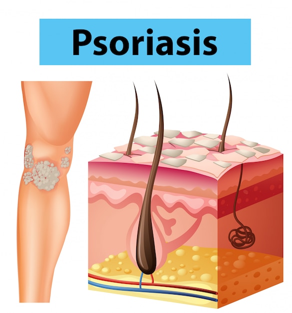 Diagramma che mostra la psoriasi sulla pelle umana