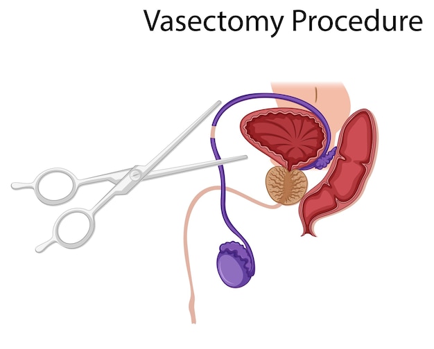 Vettore diagramma che mostra la procedura di vasectomia