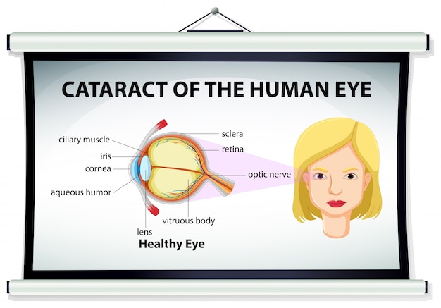 Diagram van cataract in menselijk oog