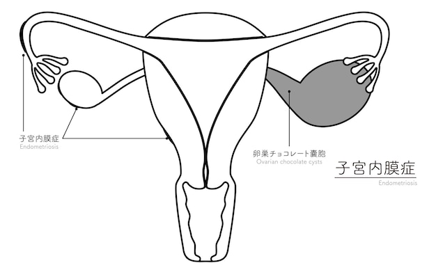 Vettore illustrazione diagrammatica dell'anatomia dell'endometriosi dell'utero e delle ovaie