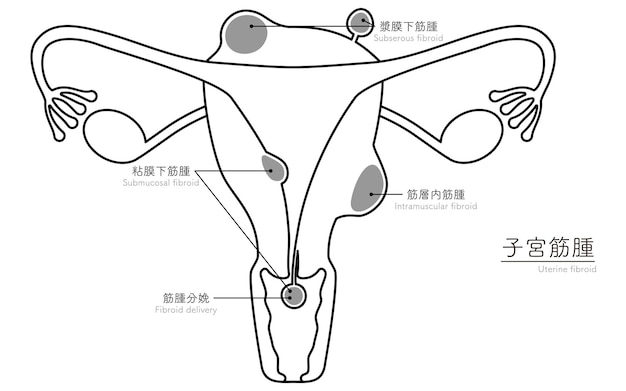 ベクトル 卵巣と子宮の解剖学