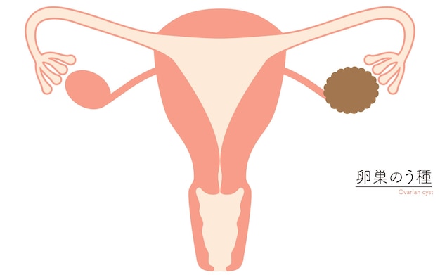 Vector diagrammatic illustration of ovarian cysts anatomy of the uterus and ovaries