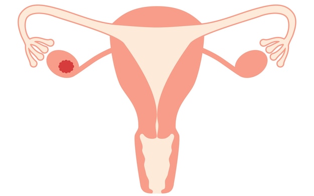 Vettore illustrazione diagrammatica dell'anatomia dell'utero e delle ovaie del cancro ovarico di stadio i