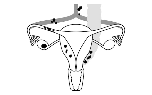 Illustrazione diagrammatica dell'anatomia dell'utero e delle ovaie del cancro ovarico di stadio iii