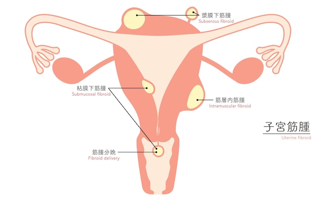 Vector diagrammatic illustration of uterine fibroids anatomy of the uterus and ovaries