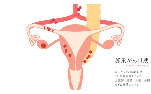 Diagrammatische illustratie van de anatomie van de baarmoeder en de eierstokken bij eierstokkanker in stadium III