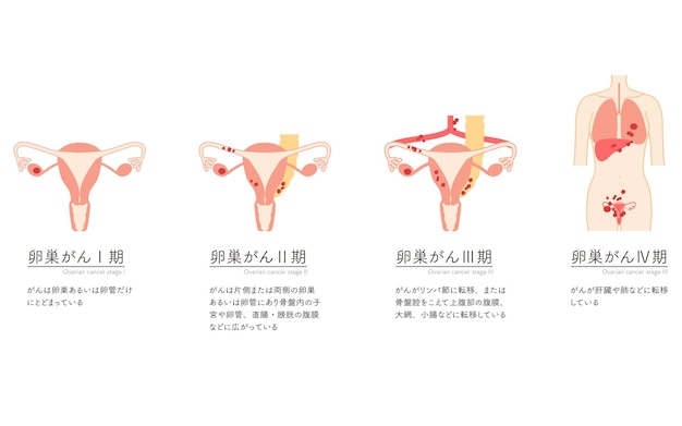 Vector diagrammatische illustratie van stadium i eierstokkanker anatomie van de baarmoeder en de eierstokken