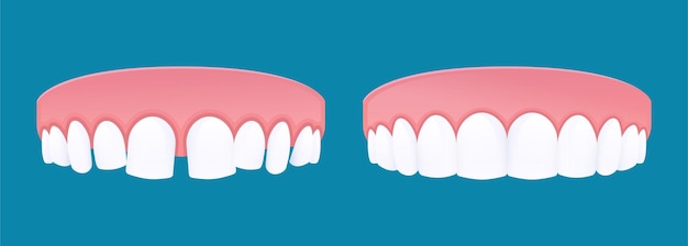 벡터 치아 간격과 건강한 치아를 가진 diastema 치아