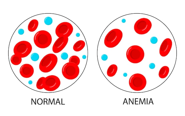 Vector the difference in anemia is the number of red blood cells and the norm