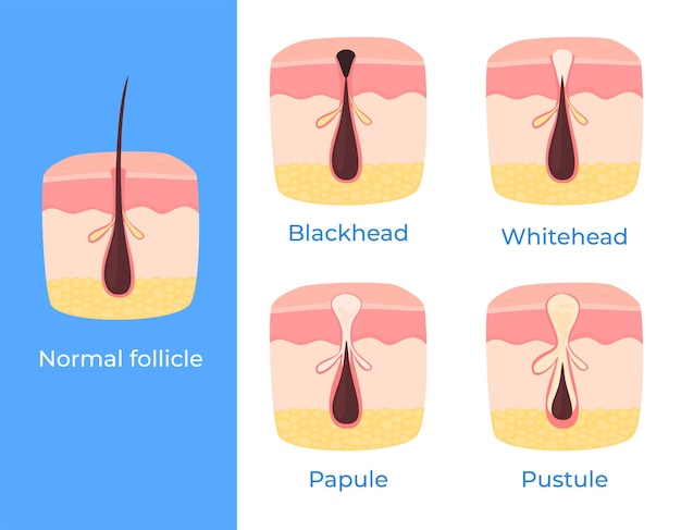 Vettore diversi tipi di problemi della pelle brufoli macchie nere acne cura della pelle illustrazione vettoriale