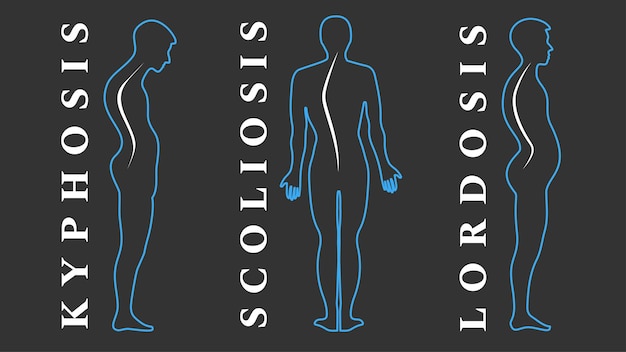 ベクトル 脊椎の病気。脊柱側弯症、脊柱前弯症、後弯症。体の姿勢の欠陥。背中の曲率。脊椎奇形タイプ。医学的疾患のインフォグラフィック。診断症状。ベクトルイラスト。