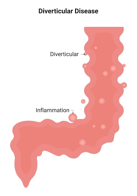 Diverticular Disease Inflammation Vector Illustration