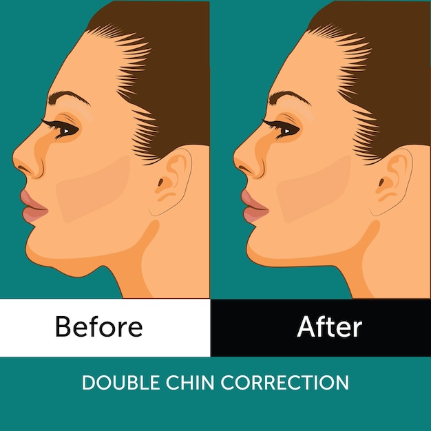 Double chin correction plastic surgery vector illustration