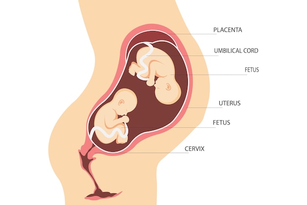 ベクトル 二重妊娠。双子の胎児を持つ子宮の解剖学.二卵性双生児の配置。フラットイラスト