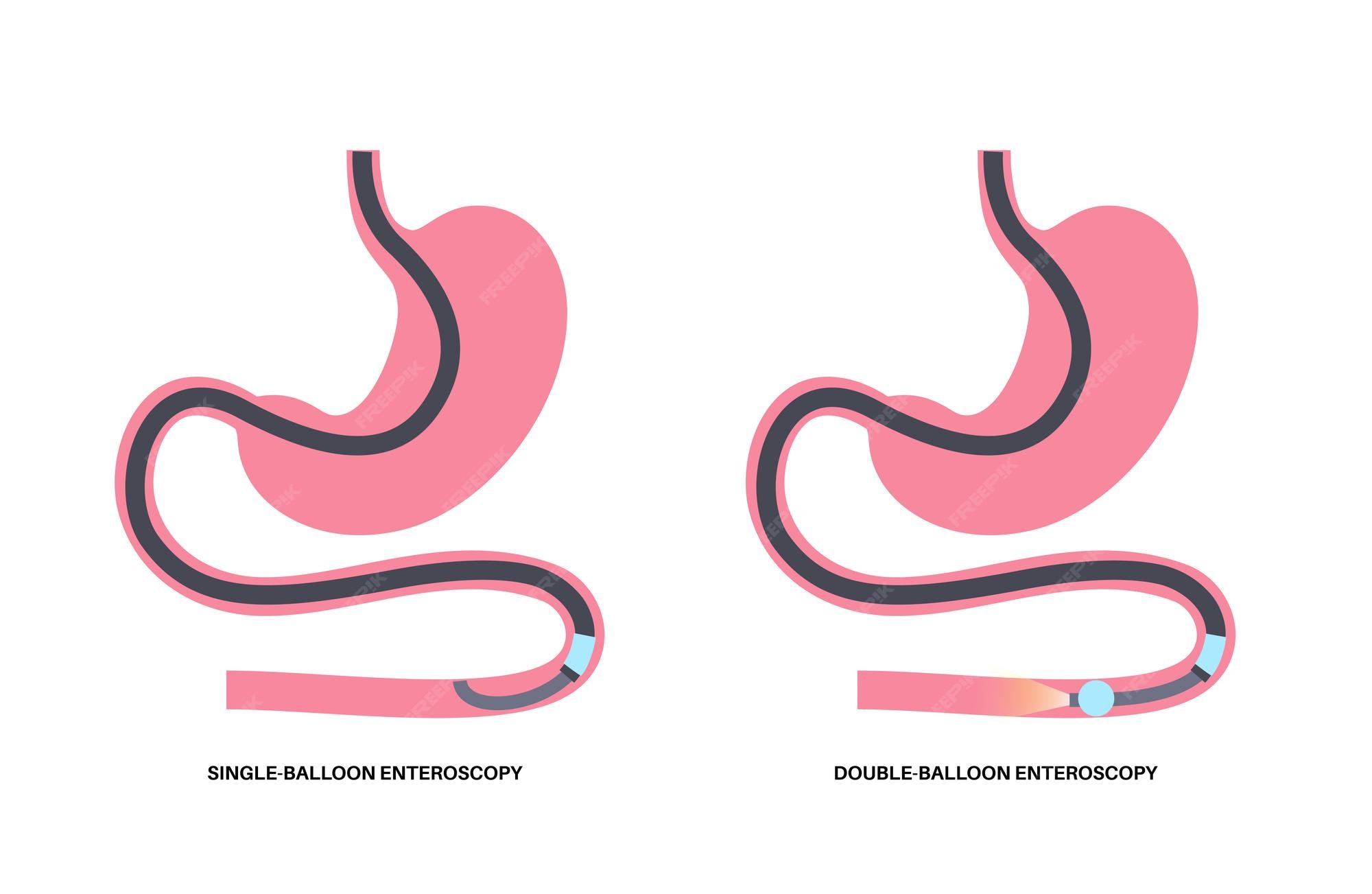 Premium Vector Double and single balloon enteroscopy minimally
