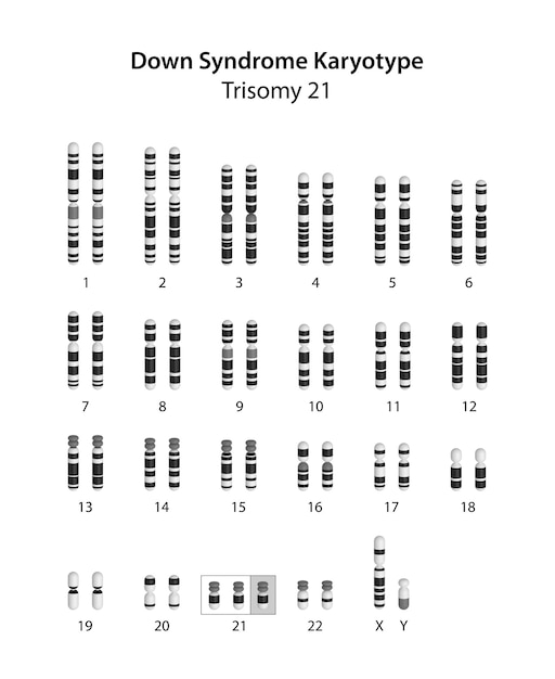 Downsyndroom trisomie 21 menselijk karyotype