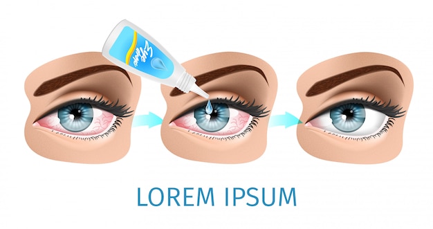 Vector dry eye syndrome scheme