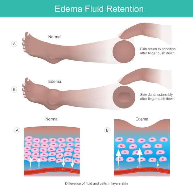 Vector edema fluid retention dents on skin after finger push down to leg result of edema symptomxa