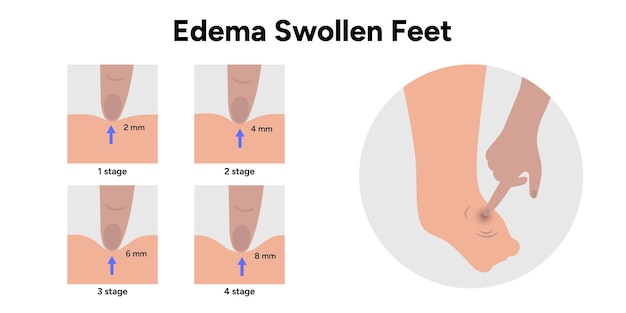 edema swollen feet