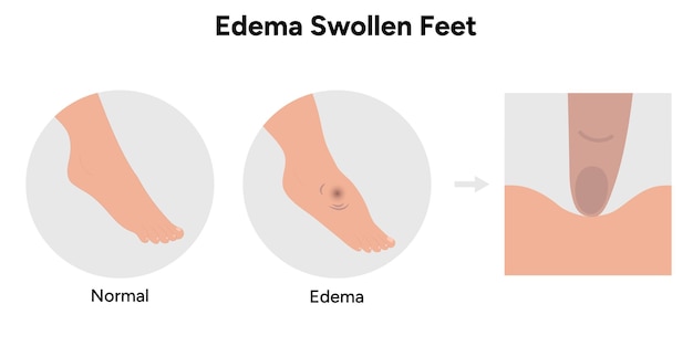 edema swollen foot and normal foot