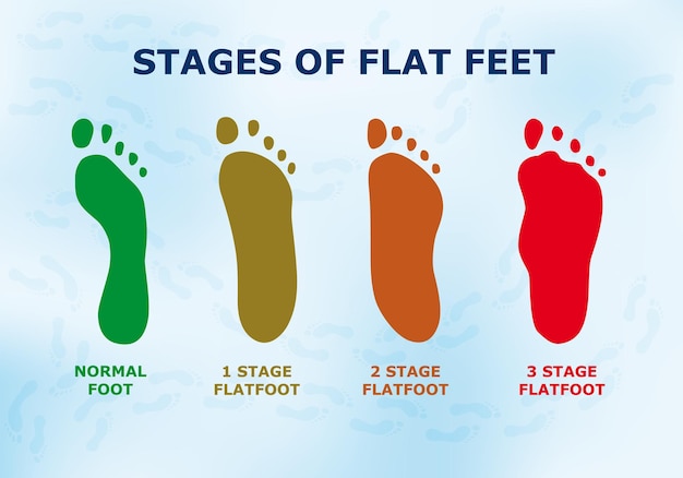 Educational poster about flat feet different stages of the disease