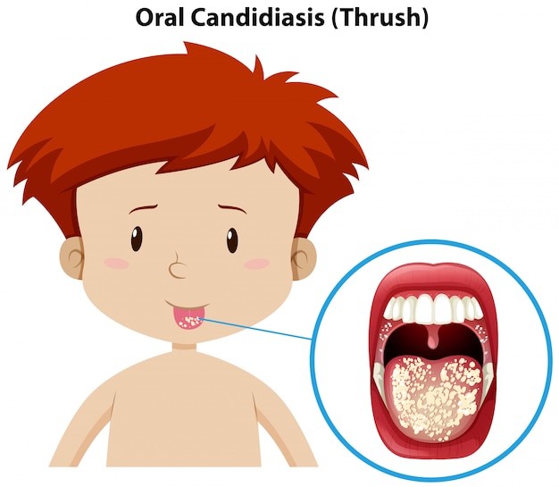 Een jonge jongen met orale candidiasis