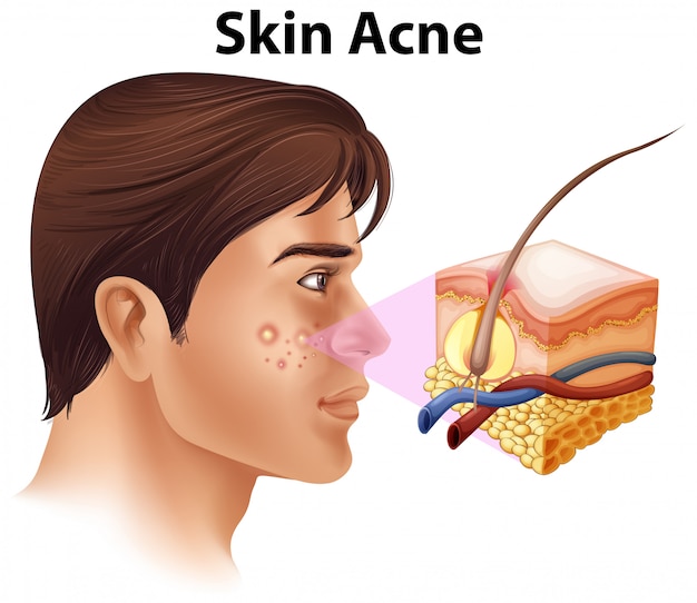 Vector een jonge man met acne probleem