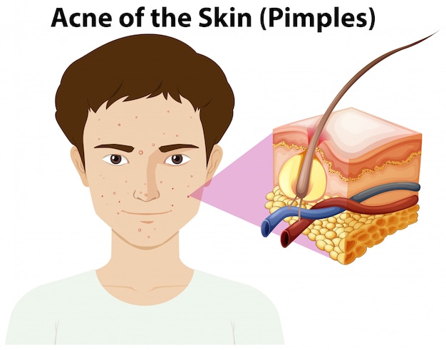 Vector een jonge man met puistje op gezicht