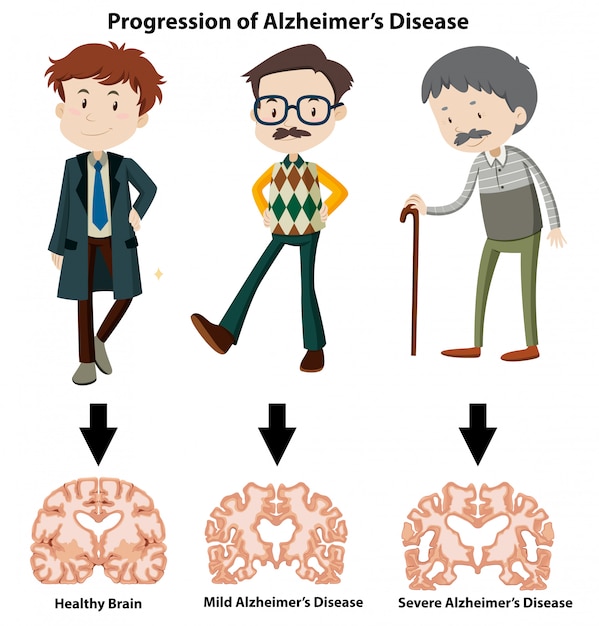 Vector een progressie van de ziekte van alzheimer