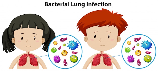 Een set van bacteriële longinfectie