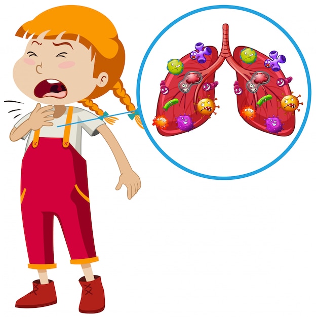 Vector een vector van lung-infectie bij meisjes