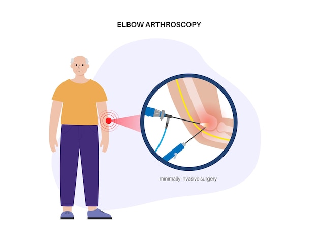 Vector elbow joint minimally invasive surgery arthroscopy medical procedure anatomy of humerus ulna and radius bones arm pain fracture osteoarthritis or rheumatoid arthritis x ray illustration