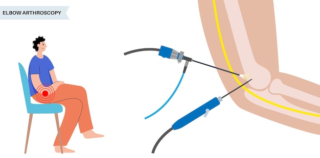 Ellebooggewricht minimaal invasieve chirurgie Artroscopie medische procedure Anatomie van opperarmbeen, ulna en radius botten Armpijn fractuur artrose of reumatoïde artritis x ray illustratie