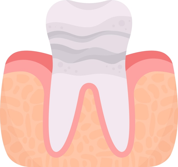 Enamel Erosion Tooth Problem