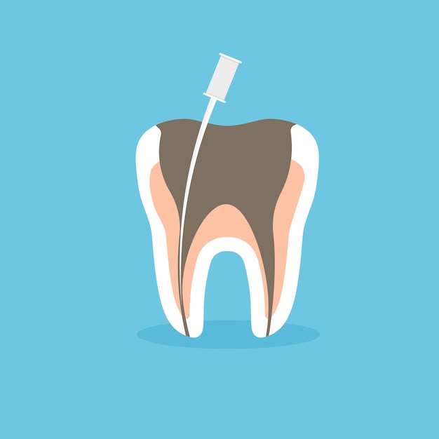 Endodontische wortelreiniging en cariësbehandelingsproces. Tandheelkundige gezondheid. Vector illustratie.