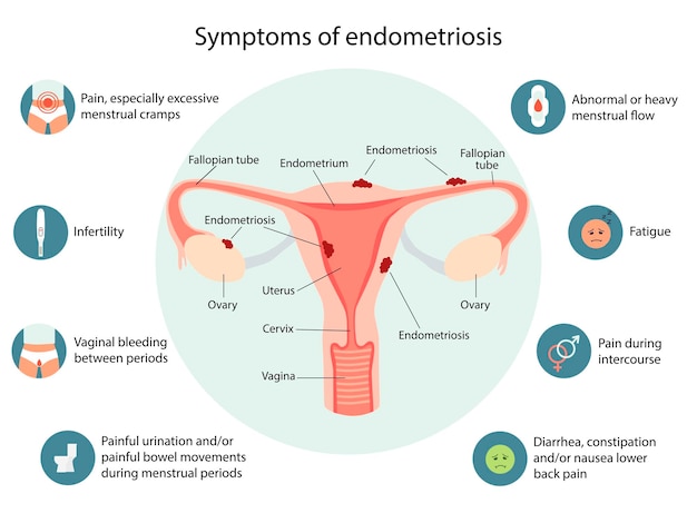 Vettore infografica sui sintomi dell'endometriosi infografica vettoriale dettagliata salute delle donne