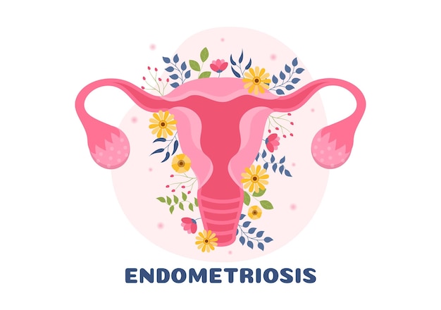 Endometriosi con condizione l'endometrio cresce al di fuori della parete uterina nelle donne nell'illustrazione